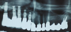 Édentation multiple 1