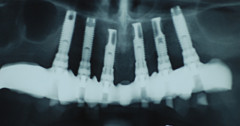 Édentation totale 3